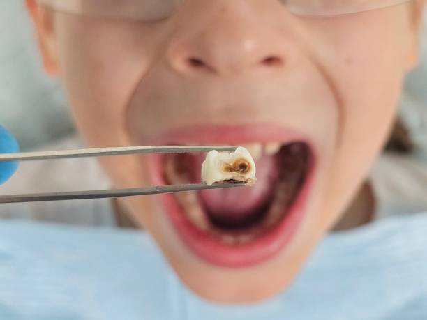 Best Knocked-Out Tooth Emergency  in Rkesburg, PA
